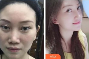 張佑陽(yáng)整形價(jià)格表附鼻部綜合案例展示