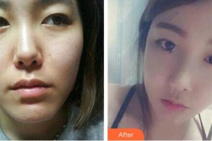 廣州壹加壹美容醫(yī)院黃其然整形價(jià)格表附埋線提升案例展示