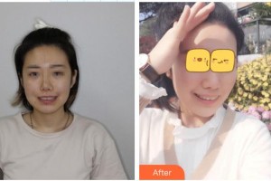 溧陽(yáng)嘉豐醫(yī)療門(mén)診部董欽曉整形價(jià)格表附牙齒隱形矯正案例展示