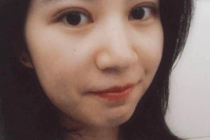 ?復旦大學附屬中山醫(yī)院怎么樣？附埋線雙眼皮果圖