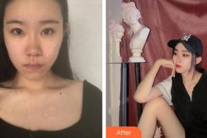 安岳潤白顏醫(yī)療整形美容門診部辛智希整形價格表附激光去紅血絲案例展示