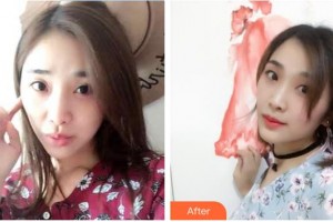 平?jīng)隹得泪t(yī)療美容門診部于曉萍整形價格表附光子嫩膚案例展示