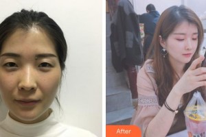 普洱云美婦產(chǎn)醫(yī)院醫(yī)療美容科文小燕整形價格表附微針水光案例展示