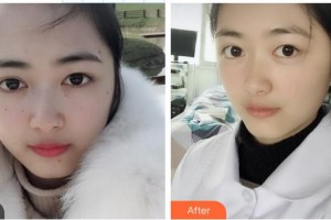 鞍鋼集團總醫(yī)院醫(yī)療美容醫(yī)院樊薔薇整形價格表附祛斑祛痣案例展示