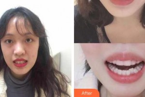 吳江邵新農(nóng)口腔診所王學娟整形價格表附口腔牙齒矯正案例展示