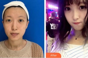 吉首市人民醫(yī)院整形美容科余強整形價格表附埋線提升案例展示