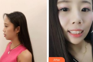 酒泉市口腔醫(yī)院常占兄整形價格表附牙齒隱形矯正案例展示