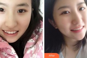 楚雄龐氏口腔門診部李惠梅整形價格表附牙齒隱形矯正案例展示