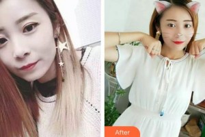 西藏阜康醫(yī)院口腔科徐蜀鳳整形價格表附金屬托槽矯正案例展示