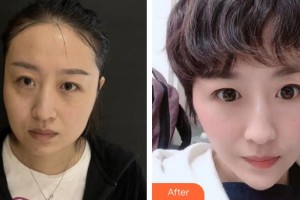 首都醫(yī)科大學附屬復興醫(yī)院整形美容中心高尚整形價格表附埋線提升案例展示