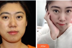 公安縣中西結合燒傷醫(yī)院燒傷整形美容科徐昌瑛整形價格表附熱瑪吉案例展示