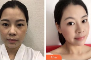 成武縣人民醫(yī)院醫(yī)學美容科張鳳云整形價格表附埋線提升案例展示