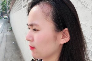 廣西醫(yī)科大一附院有稙發(fā)嗎？附發(fā)際線種植果圖