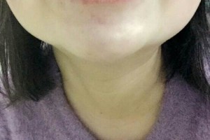 哈爾濱圣安口腔醫(yī)院怎么樣？附牙齒矯正果圖