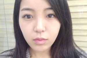 上海同濟整形醫(yī)院雙眼皮手術(shù)果案例對比圖