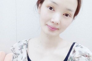 山東集美整形醫(yī)院雙眼皮手術果展示 附收費標準