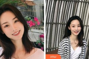 羅在德整形價(jià)格表附金屬托槽矯正案例展示