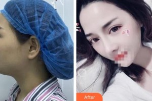 新鋼中心醫(yī)院燒傷整形科黃愛萍整形價格表附鼻部綜合案例展示