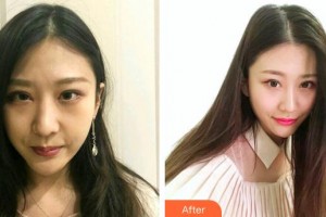 深圳杏雙醫(yī)療美容醫(yī)院王志國整形價格表附鼻部綜合案例展示
