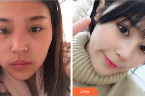富陽韓加醫(yī)療美容門診部宋建良整形價格表附鼻部綜合案例展示