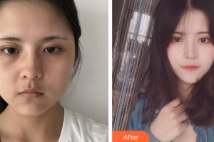 謝曼琳整形價格表附鼻部綜合案例展示