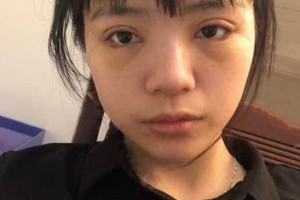 廈門(mén)海峽整形醫(yī)院雙眼皮果？附果圖及案例展示
