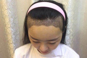 ?？谑腥嗣襻t(yī)院植發(fā)怎樣附果圖