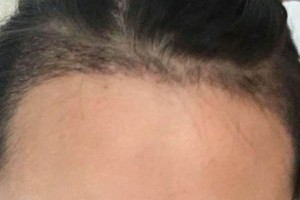 北京同仁醫(yī)院整形美容外科怎么樣？（附果圖）