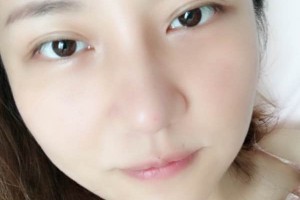 武漢亞太整形隆鼻怎么樣？真人案例+醫(yī)生介紹