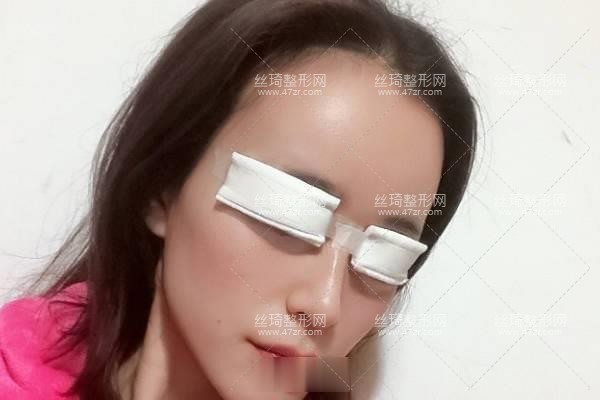 寧波113整形美容醫(yī)院？雙眼皮3個(gè)月果|整形專家詳情