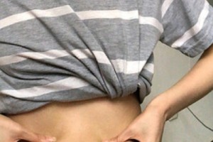 武漢涵美整形醫(yī)院怎么樣？吸脂減肥實拍—術(shù)后恢復
