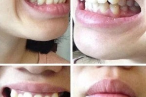 西安中諾口腔醫(yī)院評(píng)價(jià)？牙齒矯正成功案例分享！