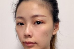 南方醫(yī)院苗勇植發(fā)果好不好？真實(shí)案例分享