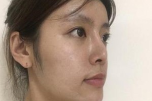 京民整形醫(yī)院假體隆鼻靠譜嗎？親身經歷分享&對比圖