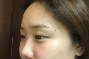 武漢協(xié)和醫(yī)院美容科怎么樣 ？去眼袋果圖