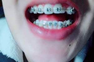 西寧醫(yī)院牙科收費(fèi)價(jià)目表｜附牙齒矯正經(jīng)歷