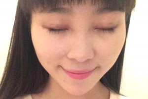 臨沂市人民醫(yī)院雙眼皮怎么樣？注意事項(xiàng)+術(shù)前準(zhǔn)備必看