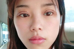 長沙亞韓整形醫(yī)院雙眼皮價(jià)格？術(shù)后幾點(diǎn)需注意！