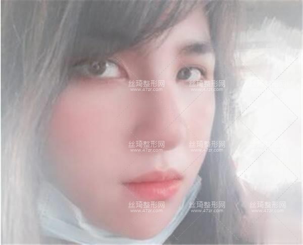 徐州二院激光美膚科隆鼻3個月果|手術(shù)費用