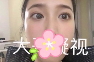 成都西嬋整形醫(yī)院雙眼皮術(shù)后恢復(fù)記錄！快看