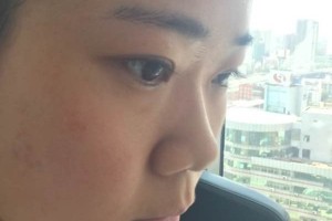 成都恩喜整形醫(yī)院膨體隆鼻正規(guī)嗎？醫(yī)生推薦