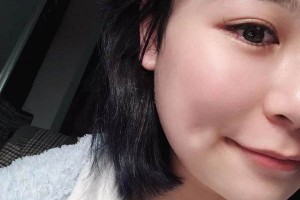 安醫(yī)二附院整形外科下頜角怎么樣？成功案例測(cè)評(píng)！