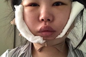 鄭大一附院有整形科怎么樣？下頜角術(shù)真實案例|醫(yī)生推薦