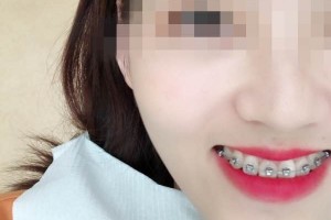青島優(yōu)諾博士口腔醫(yī)院牙齒矯正怎么樣？恢復(fù)圖分享