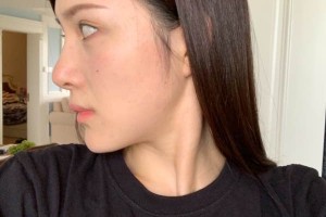 廈門第一醫(yī)院美容科下頜角怎么樣？術(shù)前術(shù)后對比圖！