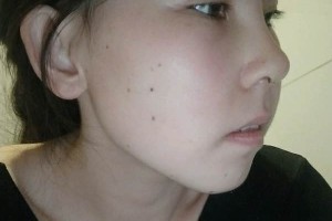 協(xié)和醫(yī)院整形科硅膠隆鼻價(jià)位？真實(shí)案例分享！