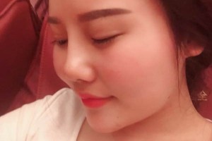 深圳北大醫(yī)院美容科膨體隆鼻好嗎？真實案例分享！