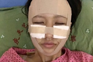 上海安縵醫(yī)療怎么樣？面部填充成功案例測評！