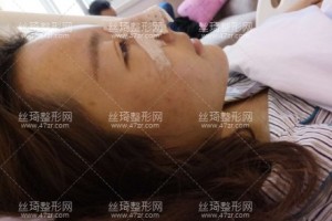 上海美賦醫(yī)療美容醫(yī)院怎么樣 ？肋骨隆鼻日記|醫(yī)生推薦
