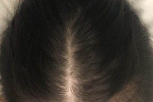 杭州新生毛發(fā)醫(yī)院種植頭發(fā)果如何？附案例圖測評！